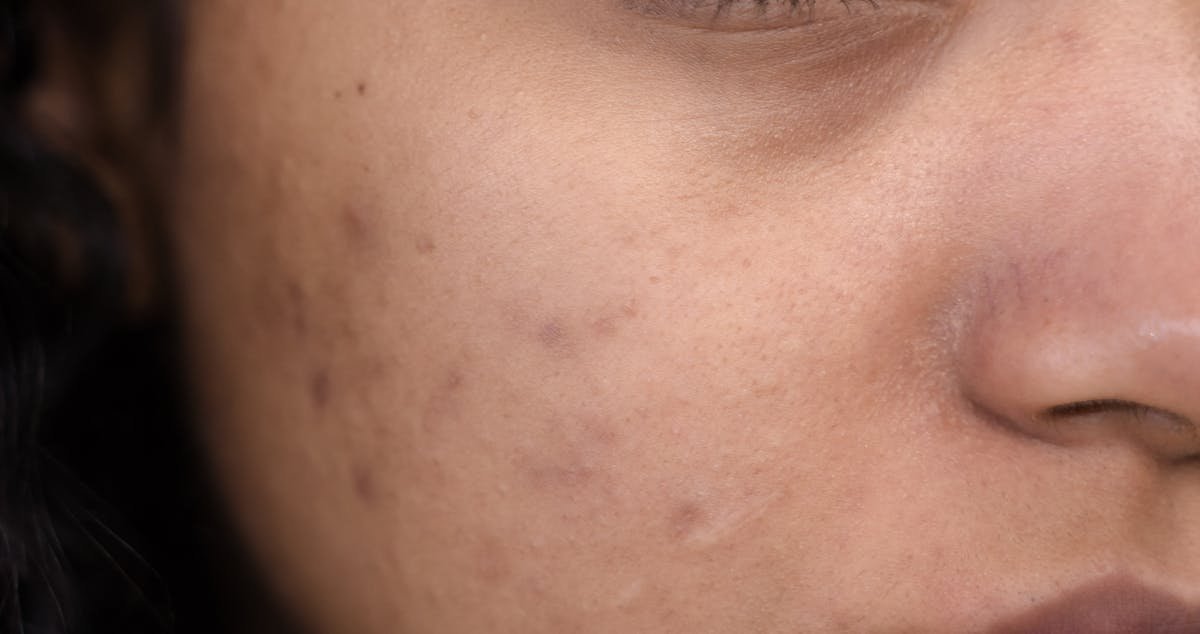 How to Clear Acne Scars With Vitamin C